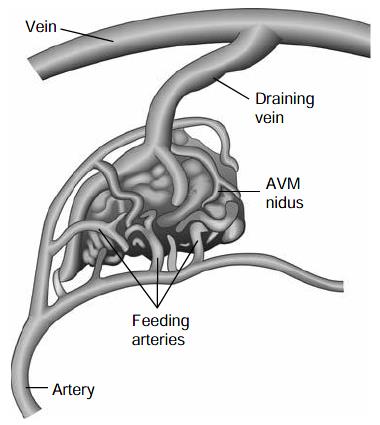 An arteriovenous malformation (AVM)