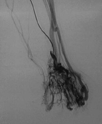Angiogram of hand and arm AVM