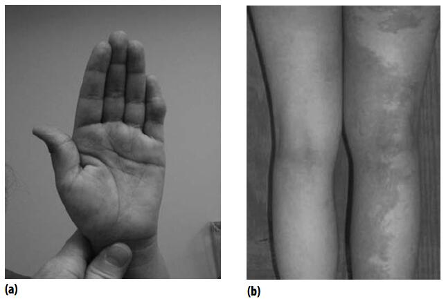 Typical vascular malformation of (a) the hand and (b) the leg
